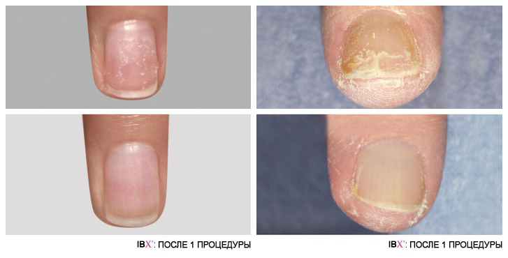 Использование IBX: фото до и после 2